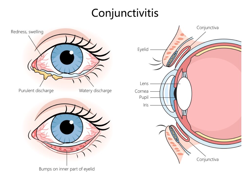 A cross section diagram of the eye depicting the location of various structures, including the conjunctiva, as well as symptoms of conjunctivitis (pink eye).